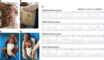 A rare homozygous variant of MC2R gene identified in a Chinese family with familial glucocorticoid deficiency type 1: A case report